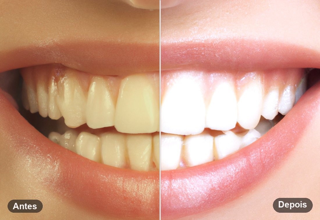 Clareamento dental