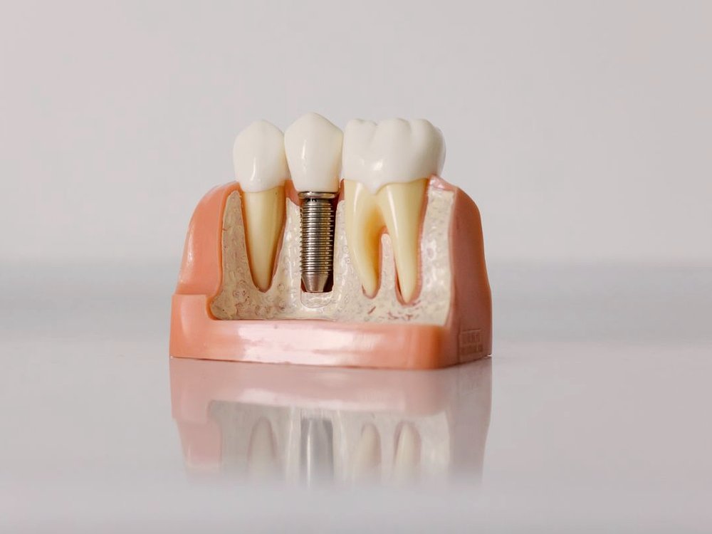 Implante dental